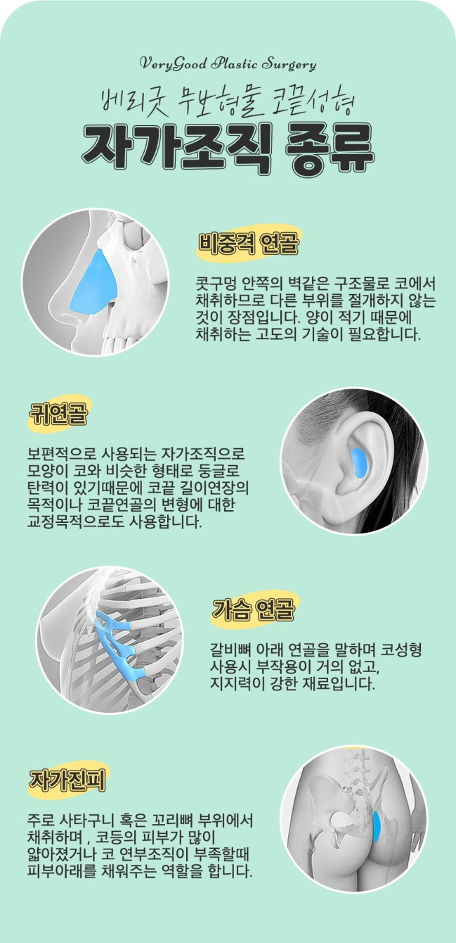 코끝처짐 오똑하게 개선 후기 무보형물 코성형 관련 이미지 3