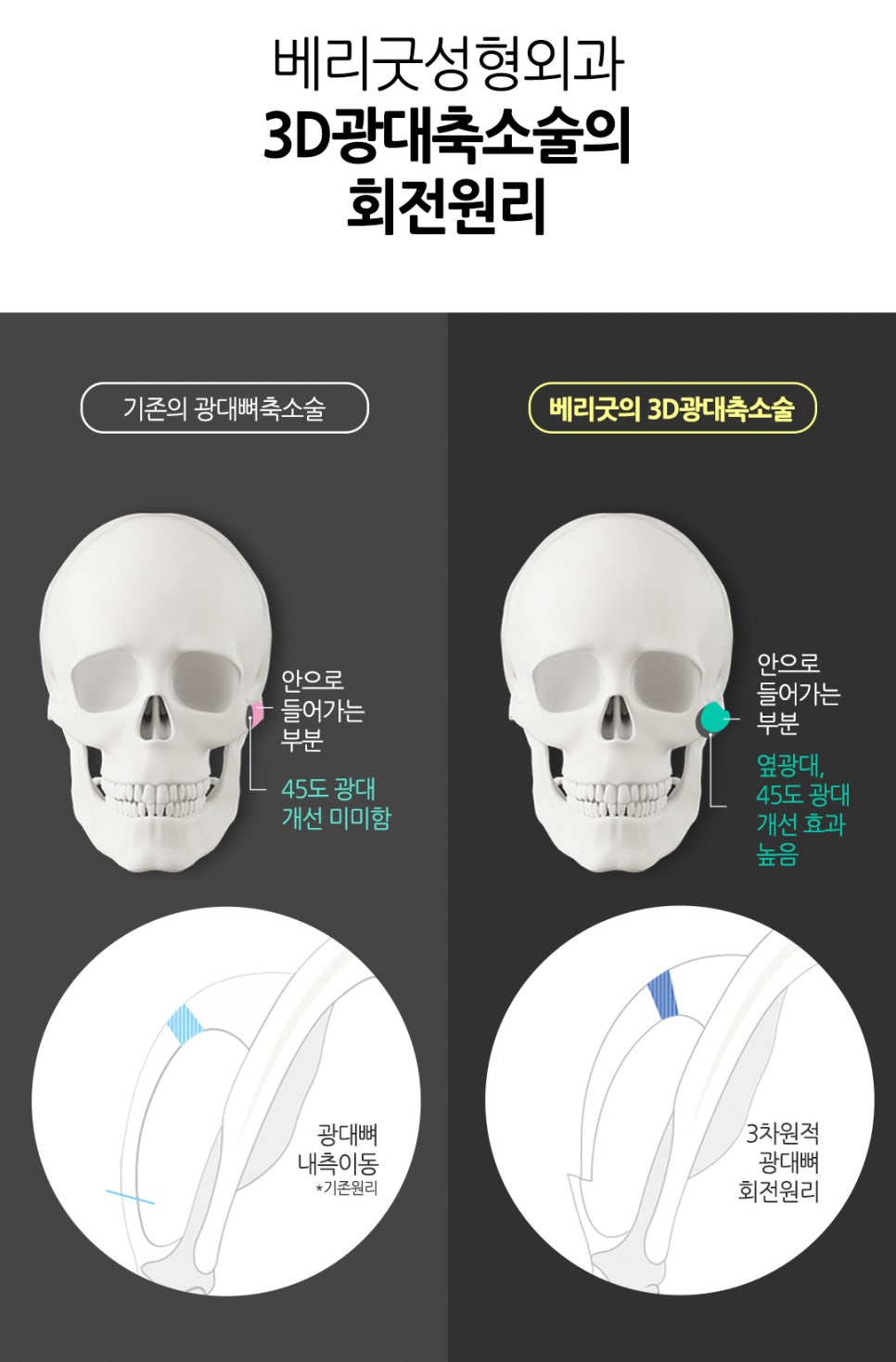 얼굴 작아지는법/ 베리굿성외과 3D광대축소술180만원 /강남역성형외과/강남역위치 관련 이미지 5
