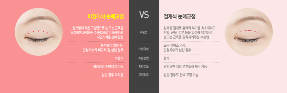 남자눈매교정전후 확실하게 관련 이미지 3