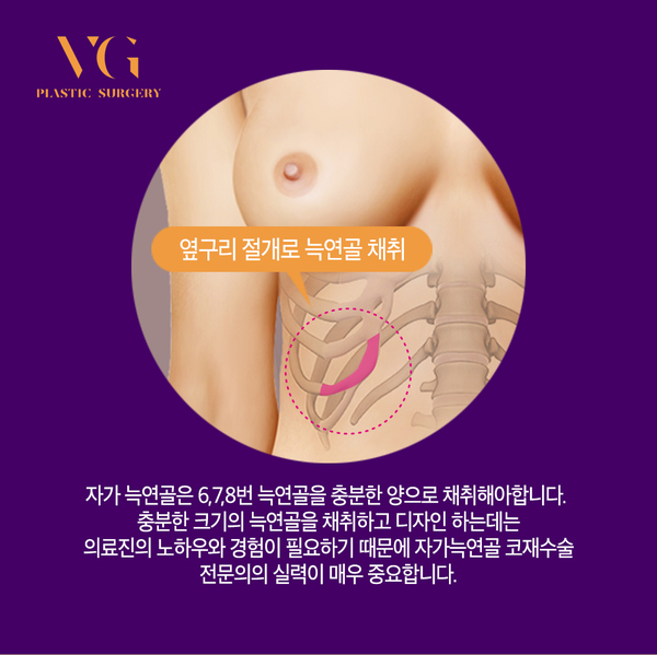늑연골코재수술, 안전하고 아름답게! 관련 이미지 6