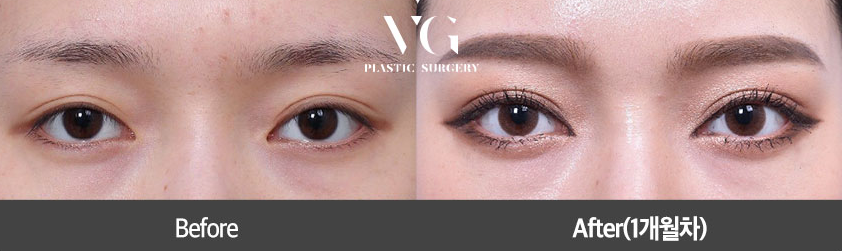 아름다움을 위한 시작, 베리굿성형외과 눈 성형(자연유착) 관련 이미지 9