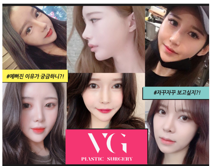 베리굿성형외과, 엑설런트 코성형! 임영민원장님의 노하우! 관련 이미지 9