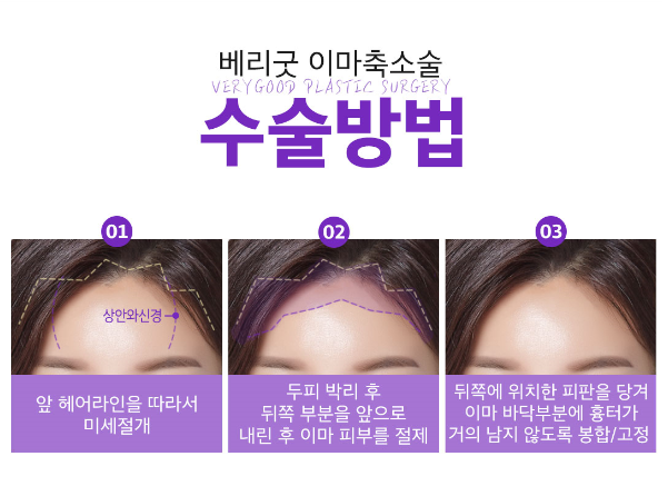 이마축소로 이상적인 이마높이 완성! 관련 이미지 4
