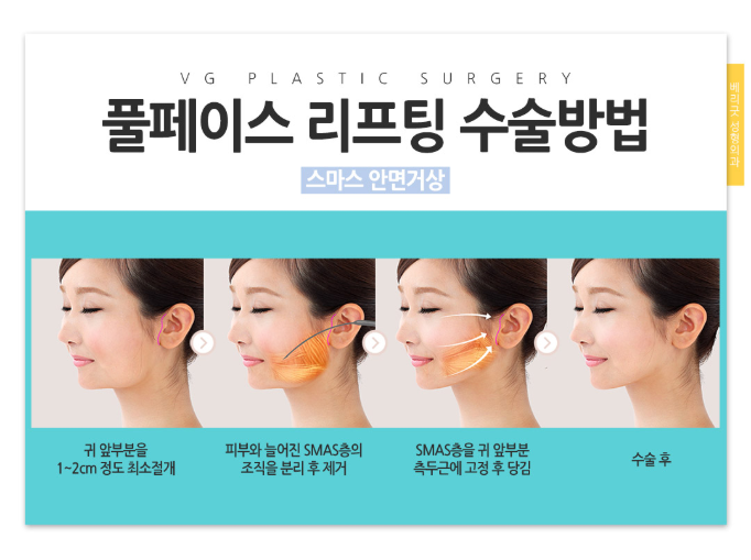 풀페이스리프팅 베리굿성형외과에서 동안얼굴 완성~! 관련 이미지 6
