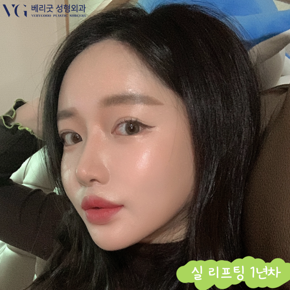 베리굿성형외과❤20,30대도 가볍게 받을 수 있는 실리프팅☝☝ 관련 이미지 1