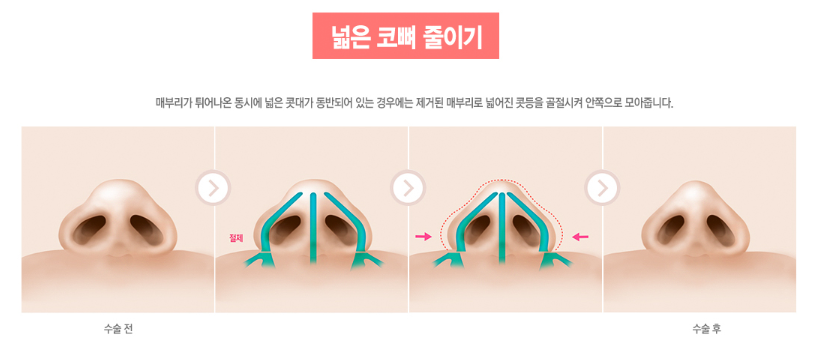 매부리코, 코성형 유형에 맞게 수술하자 관련 이미지 6