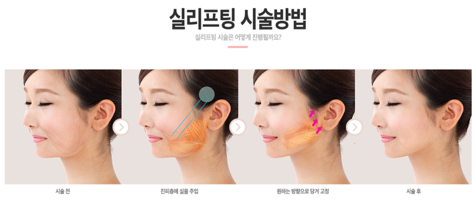 처진살로 울퉁불퉁한 얼굴라인 실리프팅으로 매끈하고 탱탱하게! 관련 이미지 3