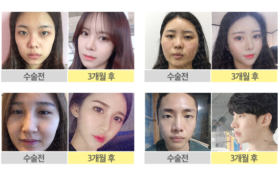 높기만한코는 이제 NO! 코성형잘하는곳! 어디일까?? 관련 이미지 7