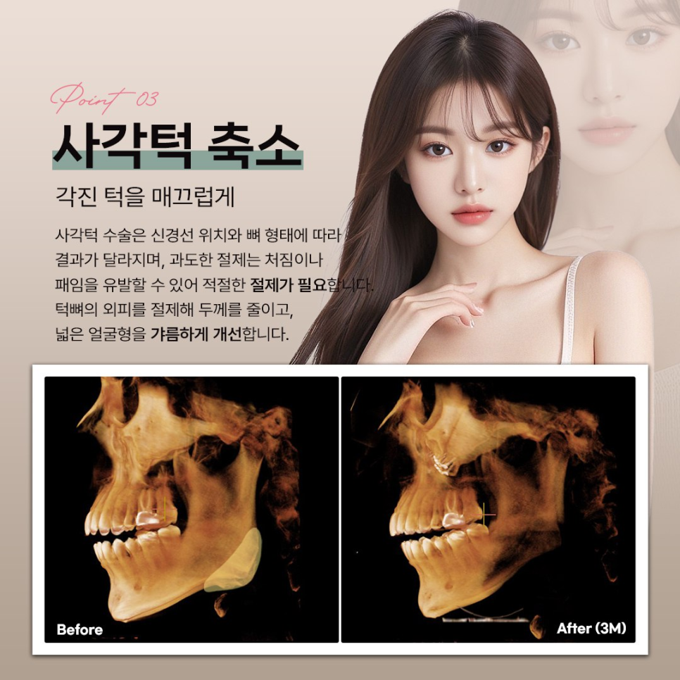 안면윤곽 수술 전 체크해야 할 3D-CT 정밀 분석의 중요성 관련 이미지 5