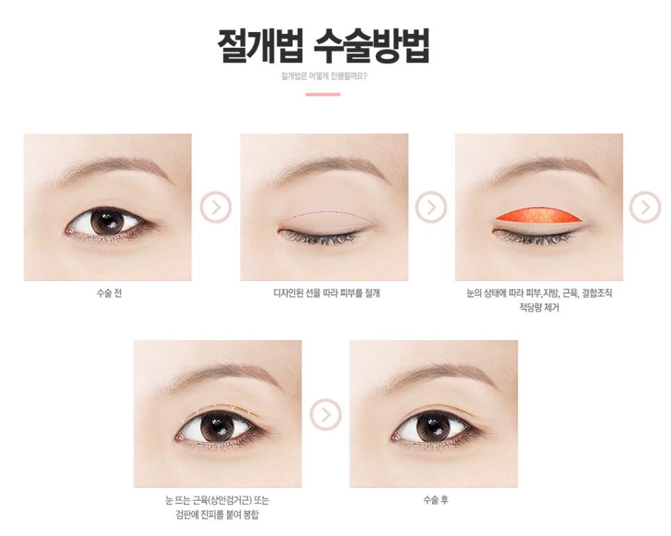절개 쌍커풀 쌍수👀❣ 잘하는곳 베리굿성형외과❤ 관련 이미지 3