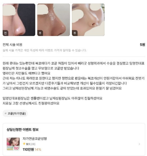 첫코수술 코끝수술 비중격교정술 하비갑개절제술 베리굿성형외과 전후후기 관련 이미지 4