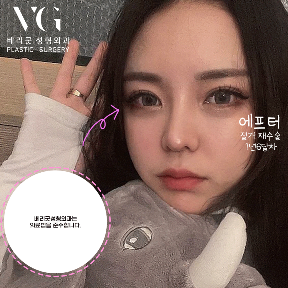 절개 쌍커풀 쌍수👀❣ 잘하는곳 베리굿성형외과❤ 관련 이미지 4