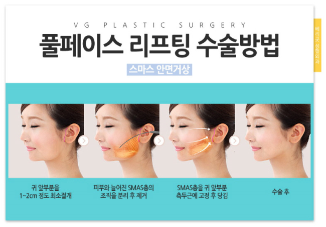 안면거상술 확실한 리프팅효과 관련 이미지 2