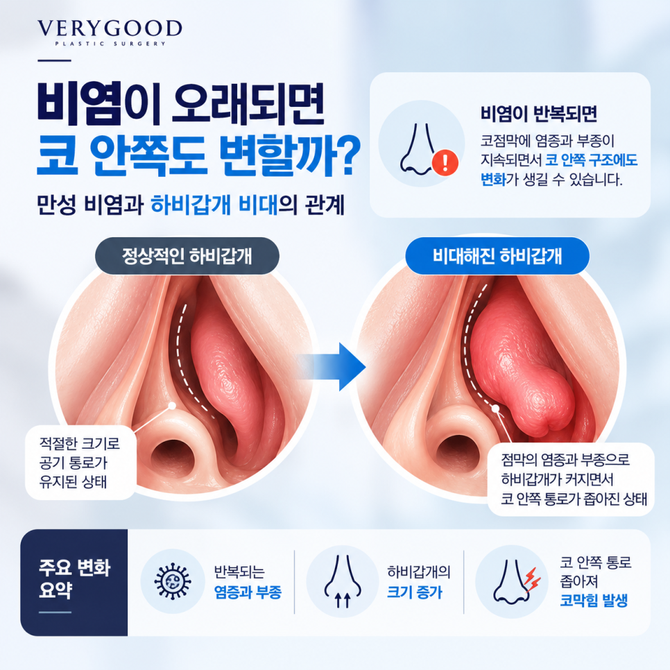 비염이 오래되면 코 안쪽도 변할까? 만성 비염과 하비갑개 비대의 관계 관련 이미지 3