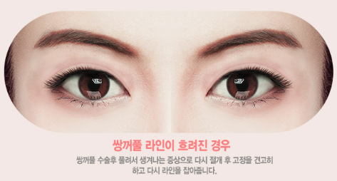 눈재수술, 원인과 상태에 따라 방법도 바뀐다? 관련 이미지 5