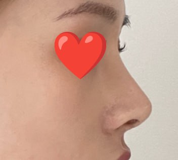 Primary Rhinoplasty with Osteotomy, Dorsal Hump Correction, Nostril Lowering, Septoplasty, and Inferior Turbinate Resection | Very Good Plastic Surgery Before-and-After Review image 2