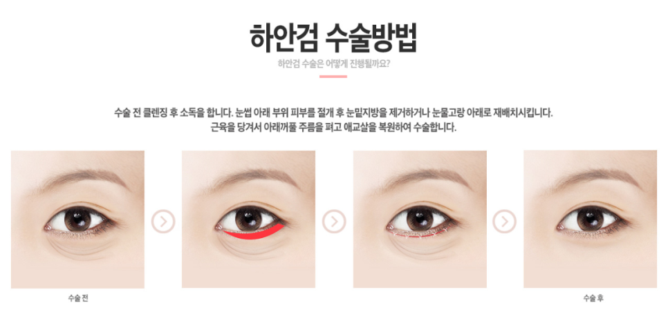10년은 젊어지는 하안검수술 효도수술이라 불리는 이유? 관련 이미지 4