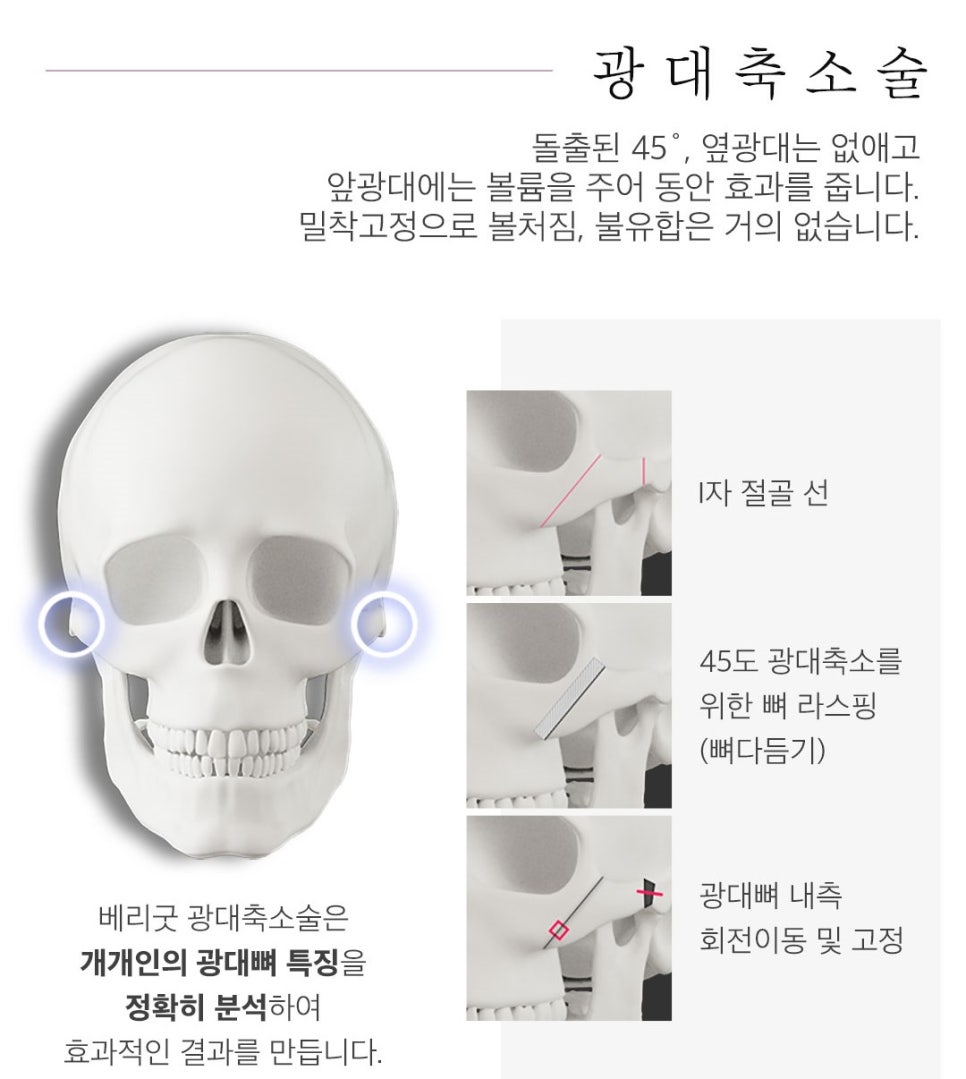 자연스러운 얼굴 라인~베리굿 남자 안면윤곽 관련 이미지 4