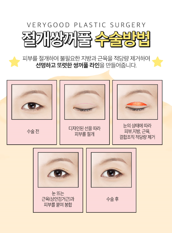 절개쌍꺼풀하고 모두의 시선을 사로잡는 또렷한 눈매 만들자! 관련 이미지 7