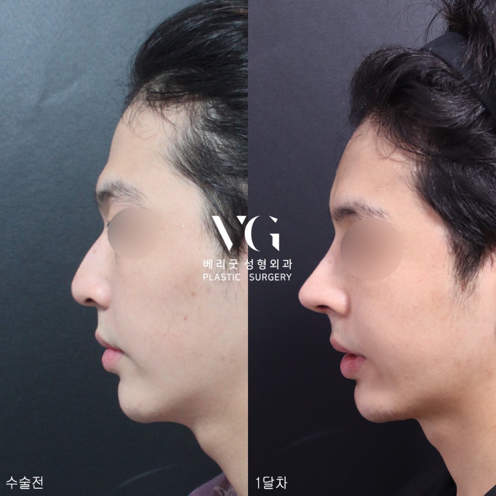 남자코성형전후가 궁금해?남자코성형도 베리굿성형외과💙 관련 이미지 1