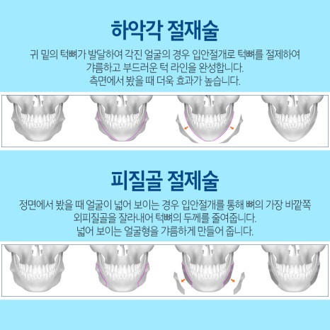 안면윤곽3종으로 매끄럽게 만족스러운 결과 관련 이미지 4