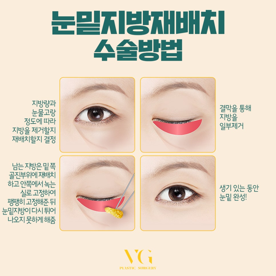 울퉁불퉁한 눈밑이 고민이라면~~ 관련 이미지 2