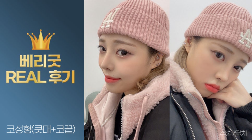 내가 예뻐진 이유❣ 베리굿성형외과 강남역 코성형 리얼후기✨ 관련 이미지 5