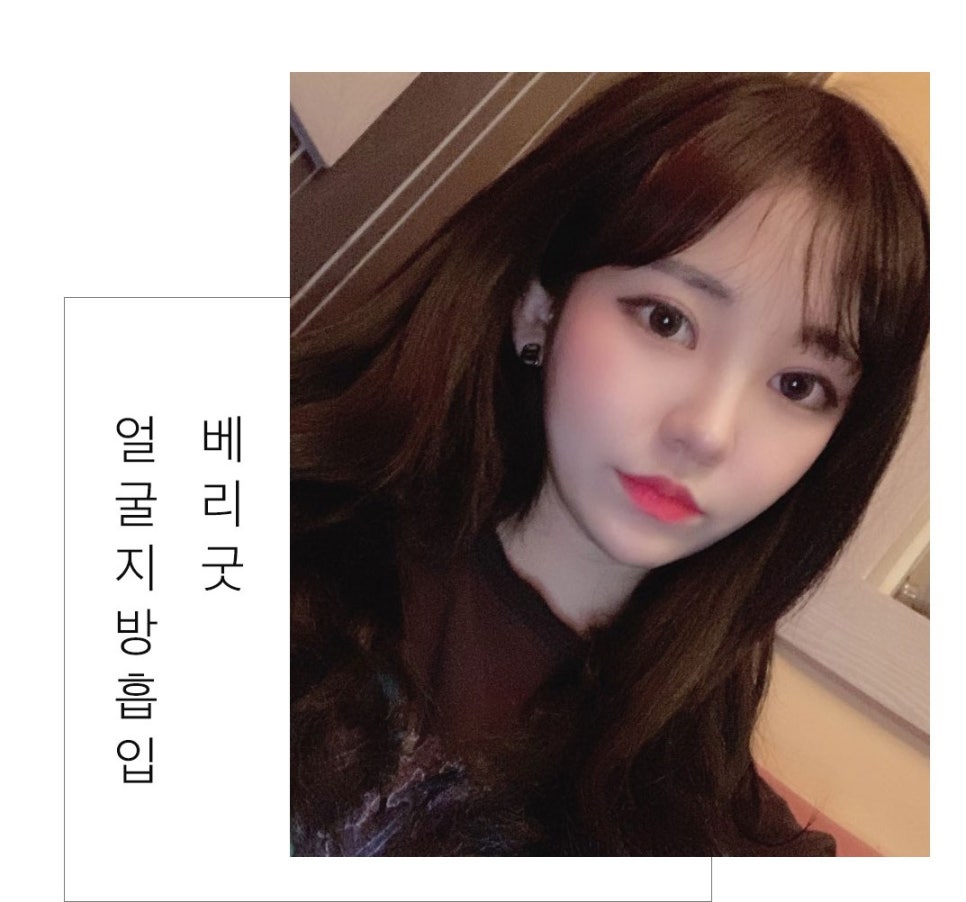 지방흡입으로 안면윤곽의 효과를?? 관련 이미지 4