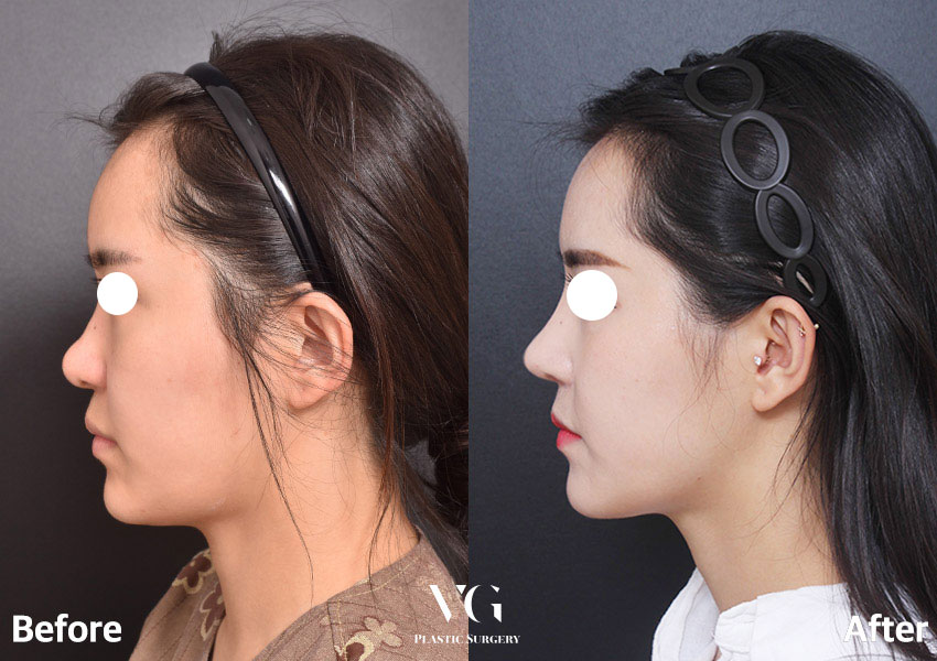 [ 베리굿성형외과 ] 베일듯한 코라인 베리굿 복코 찐 전후비교 관련 이미지 1