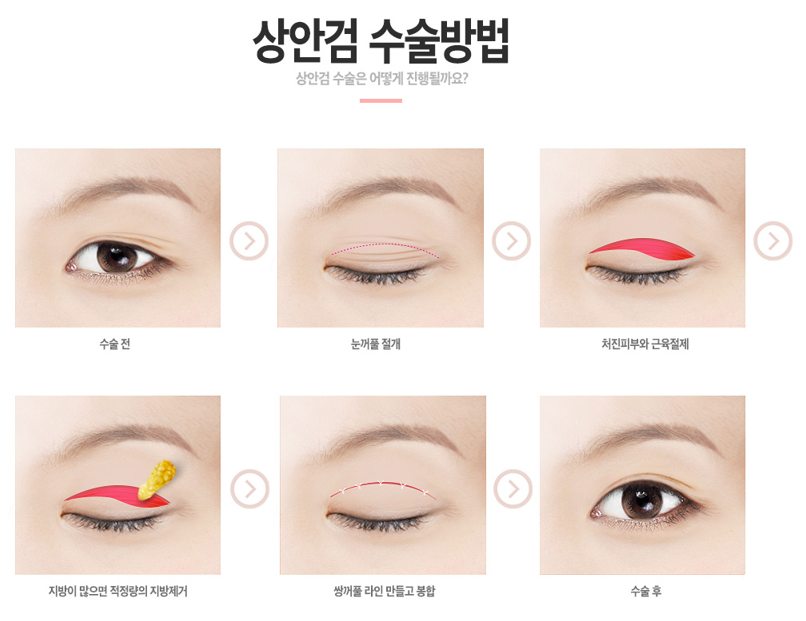 상안검수술잘하는곳 젊고 아름다운 눈매 만들자 관련 이미지 3
