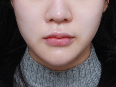 사각턱축소술로 안면 비대칭교정도 가능하다?? 관련 이미지 4