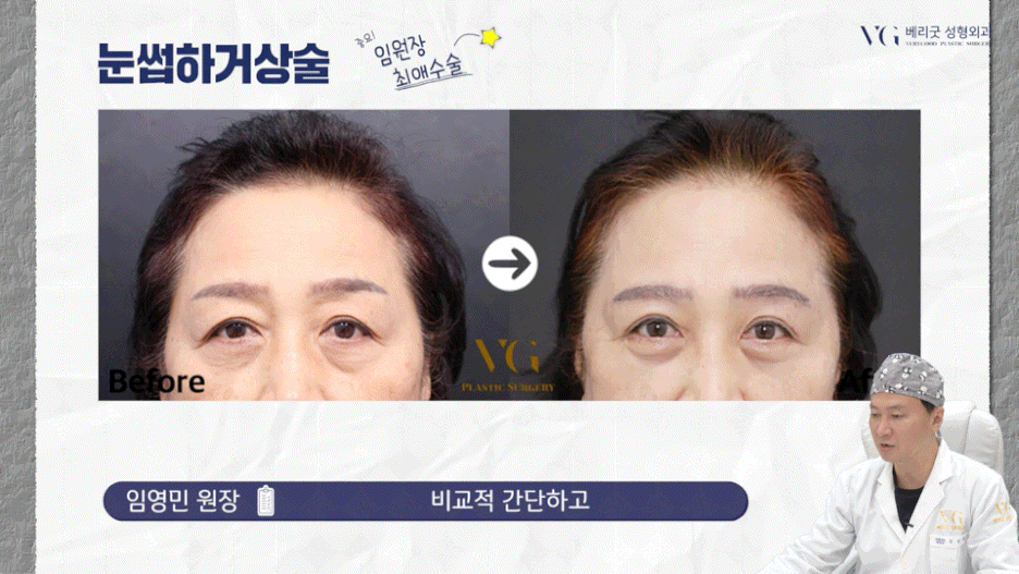 강남중년눈성형 잘하는곳 , 상안검 하안검 눈썹하거상술종류 진행방법 궁금하다면 관련 이미지 14