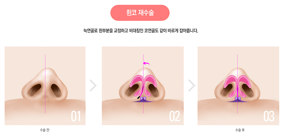 베리굿성형외과의 VERYGOOD한! 자가늑코재수술 전후 관련 이미지 8