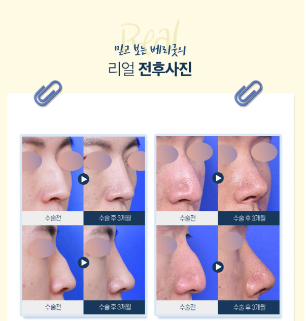 남자코성형! 뭐부터 알아봐야할까? 관련 이미지 4