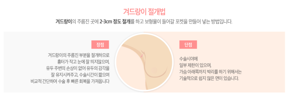 마른A컵도 가능🙈❤ 베리굿 성형외과의 베리굿 가슴성형✨ 관련 이미지 4