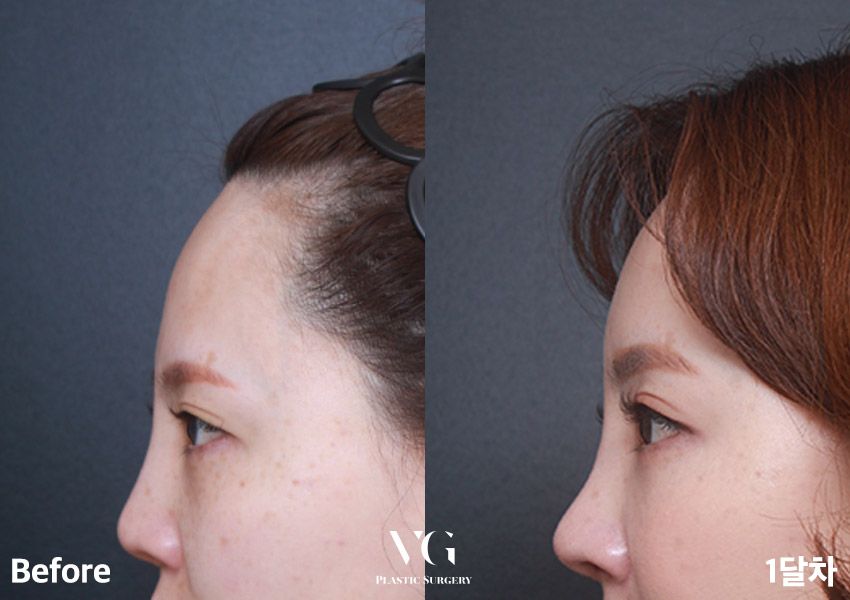 답답한 눈매? 무거운 눈? 베리굿 이마거상전후로 해결👀💖 관련 이미지 6