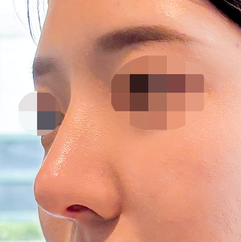 Primary Rhinoplasty, Osteotomy, Hump Correction, Septoplasty, Inferior Turbinate Resection | 베리굿성형외과 Before-and-After Review image 2