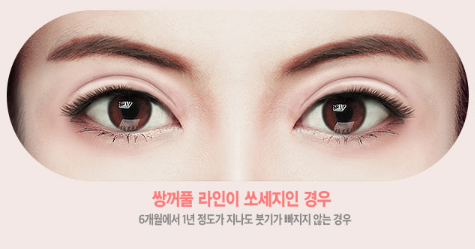 눈재수술, 원인과 상태에 따라 방법도 바뀐다? 관련 이미지 7