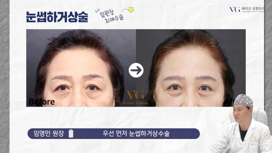 강남중년눈성형 잘하는곳 , 상안검 하안검 눈썹하거상술종류 진행방법 궁금하다면 관련 이미지 12