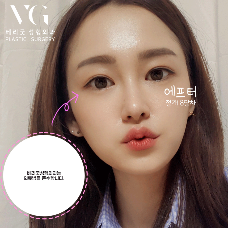 절개 쌍커풀 쌍수👀❣ 잘하는곳 베리굿성형외과❤ 관련 이미지 7