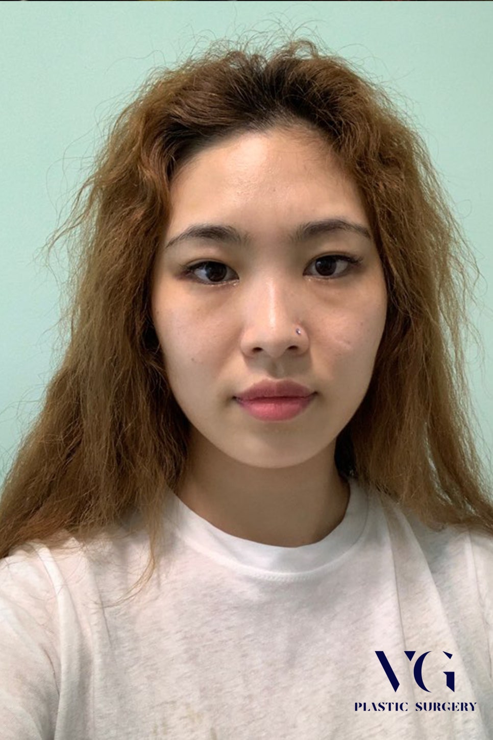 베리굿 눈재수술로 마지막을 완성하다! 관련 이미지 2