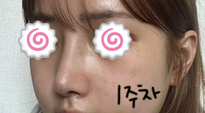 첫코수술 낮은코수술 자가늑연골 귀연골 베리굿성형외과 전후후기 관련 이미지 2