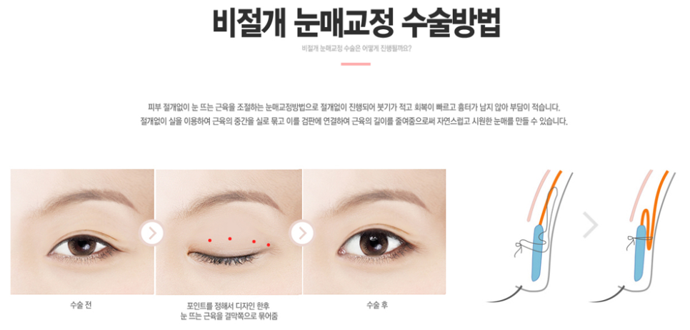 비절개눈매교정 또렷하고 선명한 인상으로! 관련 이미지 4
