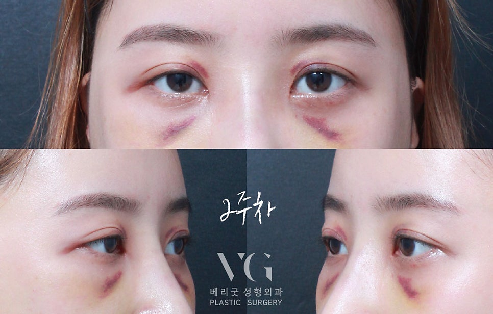 다크서클 없애는 눈밑지방재배치(눈밑지)베리굿성형외과 전후✨ 관련 이미지 6