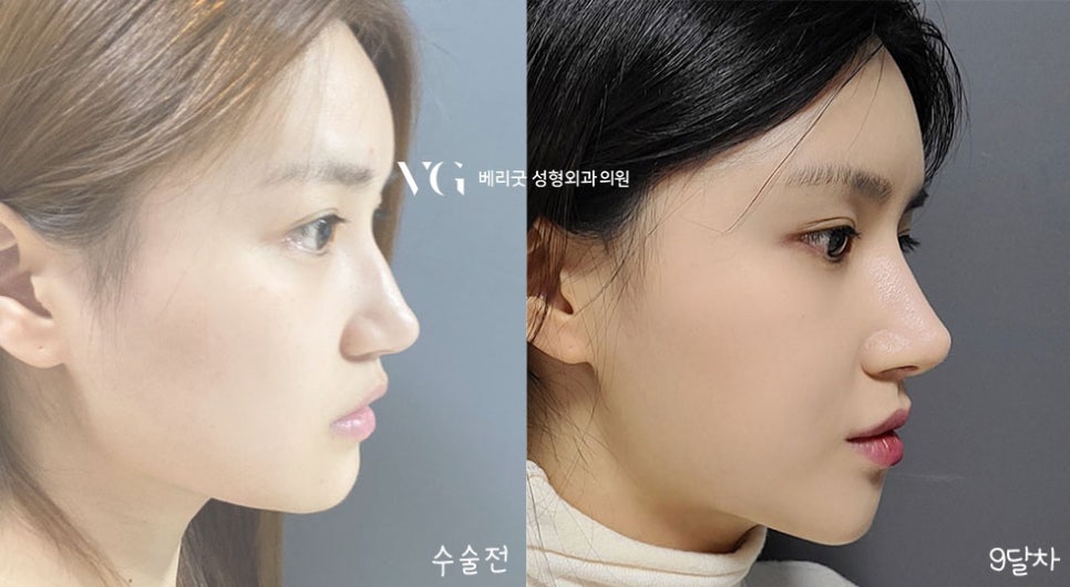 교정 없이! 발치 없이! 코성형으로 돌출입교정하자 ❤베리굿성형외과❤ 관련 이미지 7