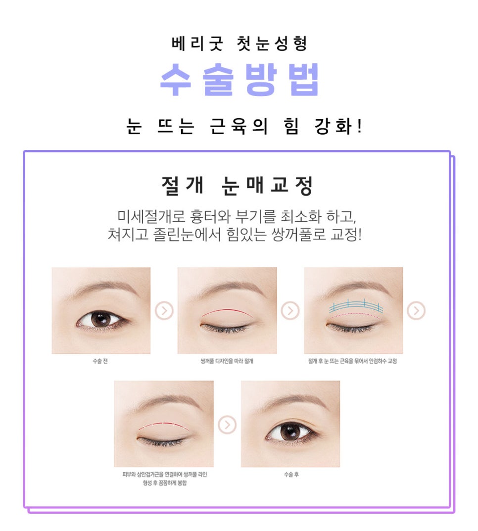 아름다운 당신을 위한 베리굿의 첫눈성형 관련 이미지 7