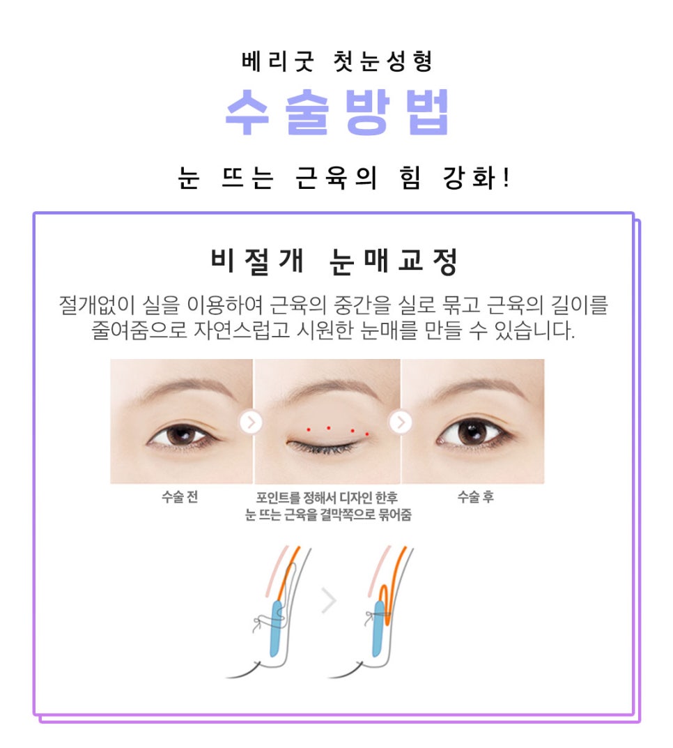 아름다운 당신을 위한 베리굿의 첫눈성형 관련 이미지 6
