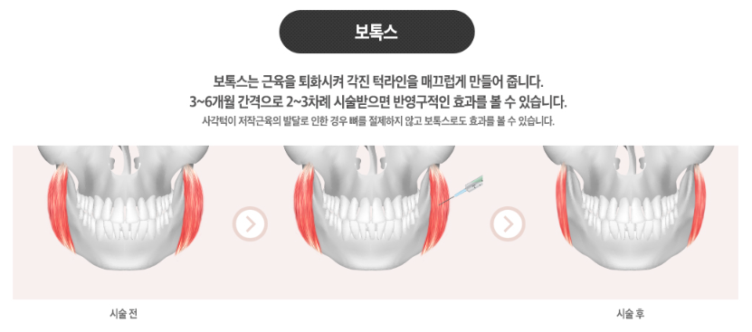 사각턱축소 내게 맞는 라인으로 관련 이미지 4