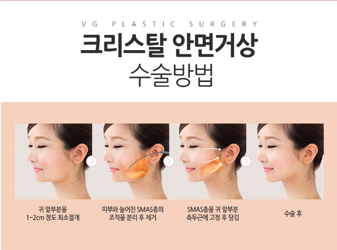 깊은 얼굴주름을 개선시켜주는 안면거상 관련 이미지 4