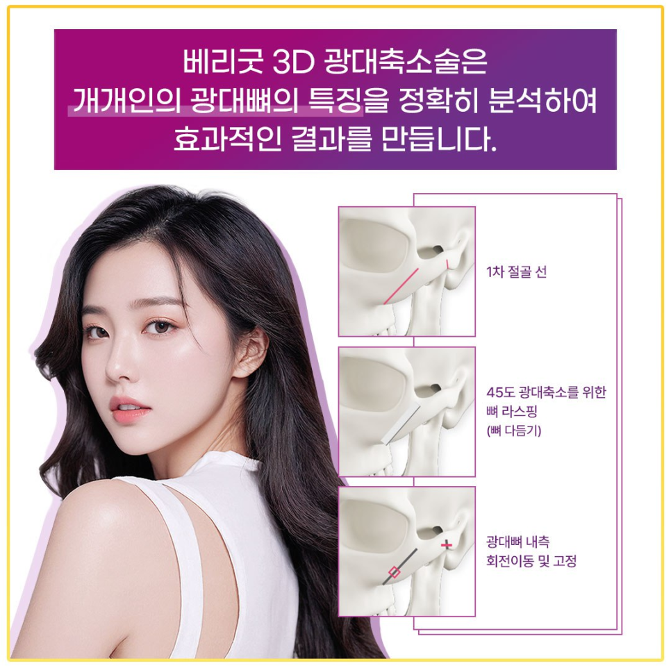 정면&middot;측면 모두 매끄럽고 작아 보이는 얼굴, 강남 베리굿성형외과 광대축소술 관련 이미지 3